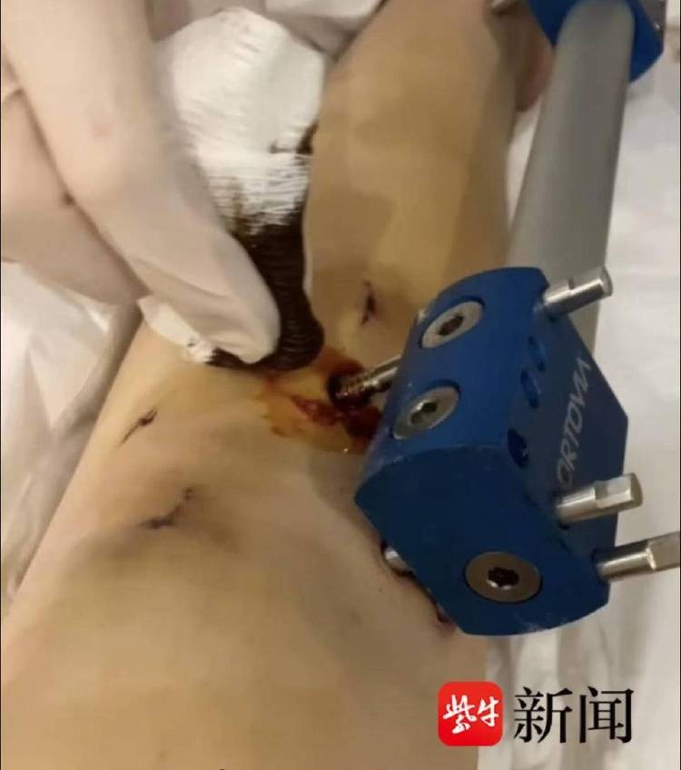 非洲足球冠军联赛
_女子去国外“断骨增高”非洲足球冠军联赛
，后遗症缠身维权难：像有定时炸弹藏在身体里