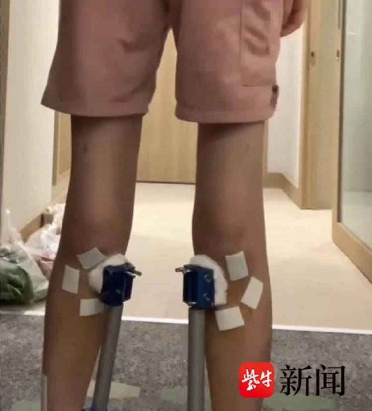 非洲足球冠军联赛
_女子去国外“断骨增高”非洲足球冠军联赛
，后遗症缠身维权难：像有定时炸弹藏在身体里