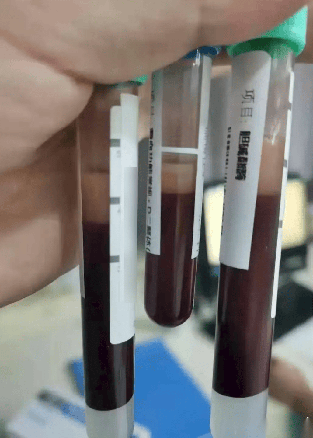 阿德萊得城 vs 克罗伊登_一口气干掉5只阿德萊得城 vs 克罗伊登,宁波男子被连夜送急诊!正大量上市!医生提醒:一次别超过2只