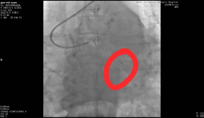 皇冠信用网_河南一老人做冠脉造影手术时一截导丝断在血管中皇冠信用网!院方回应