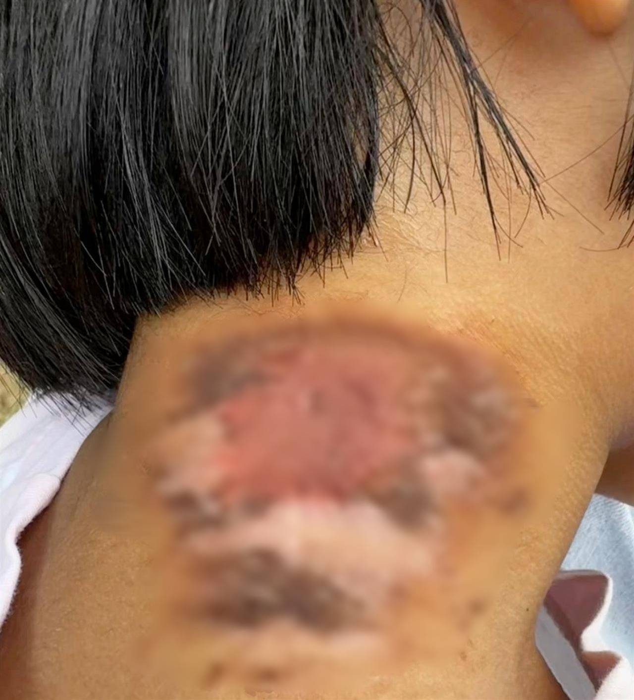 如何代理皇冠信用网_河南多地现“行走的硫酸”:洛阳一工地脚手架密密麻麻全是如何代理皇冠信用网,南阳4岁女童沾上它脖子红肿溃烂20余天未痊愈