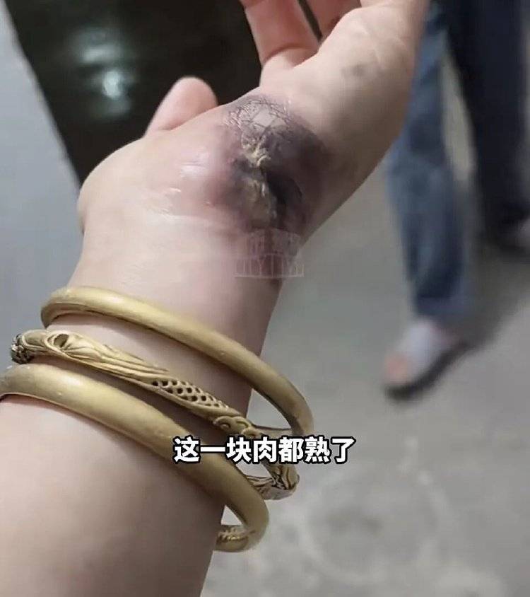 世界杯信用网平台出租
_手被烧熟!金手镯被烧熔!女子给电动车充电世界杯信用网平台出租
,不慎碰到充电口受伤